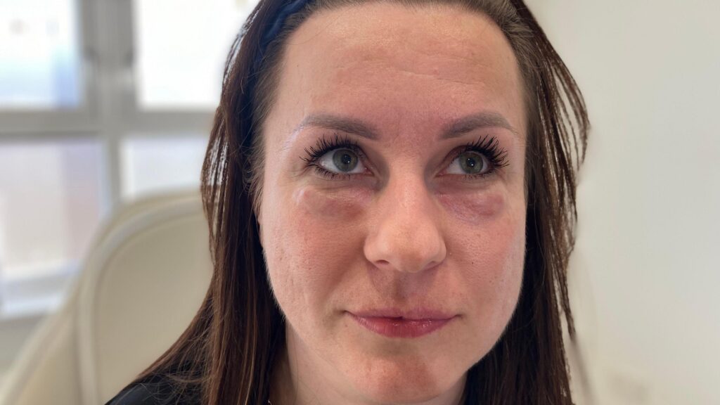 Renata Wojno's skin care treatment gone wrong and formed lumps after a Botox injection under her eyes